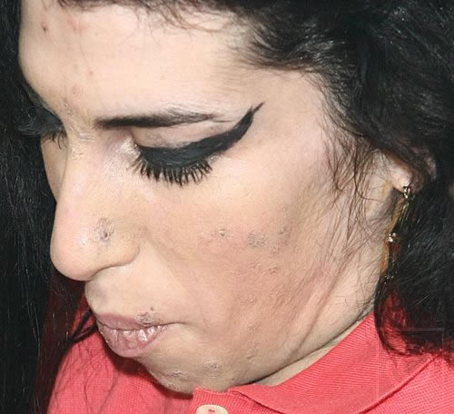 Amy Winehouse volvió a rehabilitación
