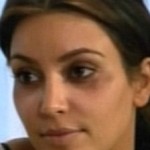 Kim Kardashian ojos morados por Botox 7