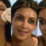 Kim Kardashian ojos morados por Botox port
